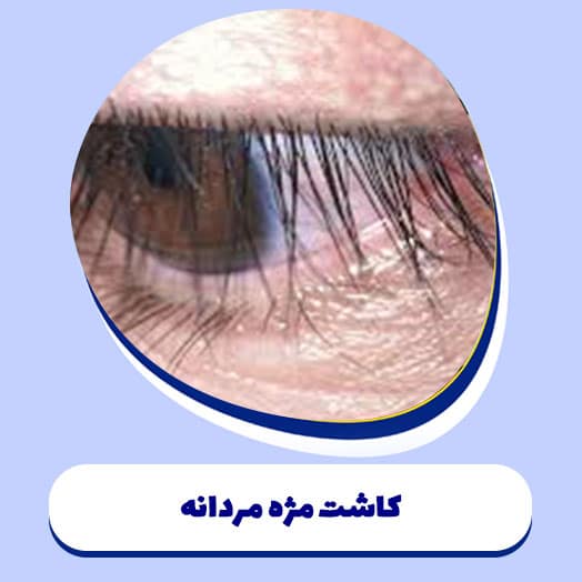 کاشت مژه مردانه